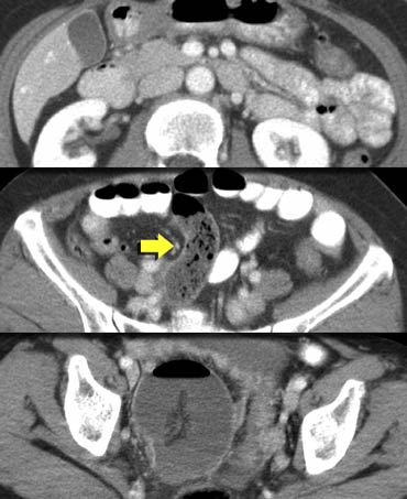 Closed loop obstruction and small bowel feces sign in a patient with non-dilated proximal bowel